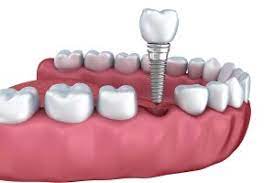 Revive Your Smile with Dental Implants: The Ultimate Solution - Read News Blog