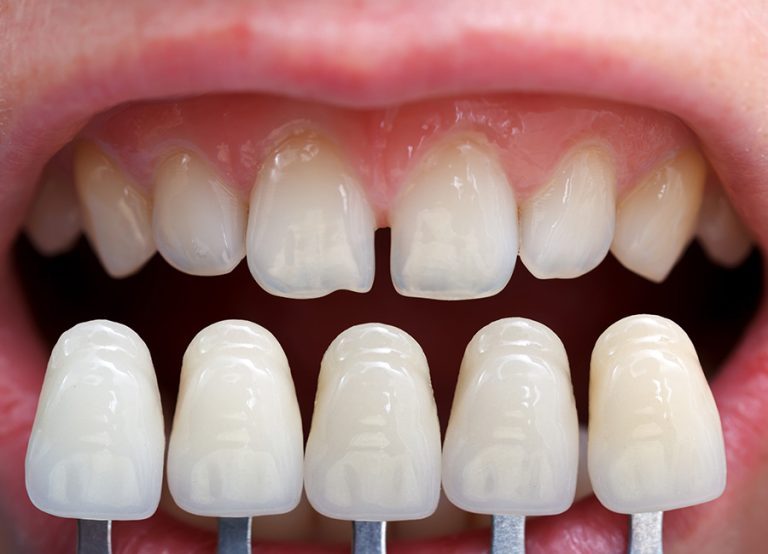 Get The Perfect Smile With Dental Veneers - WriteUpCafe.com