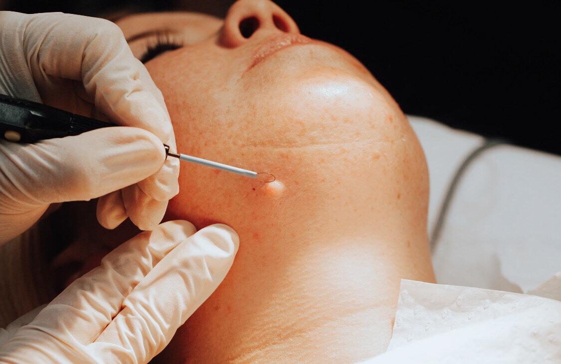 How to Prepare for Skin Lesion Removal by a Plastic Surgeon?