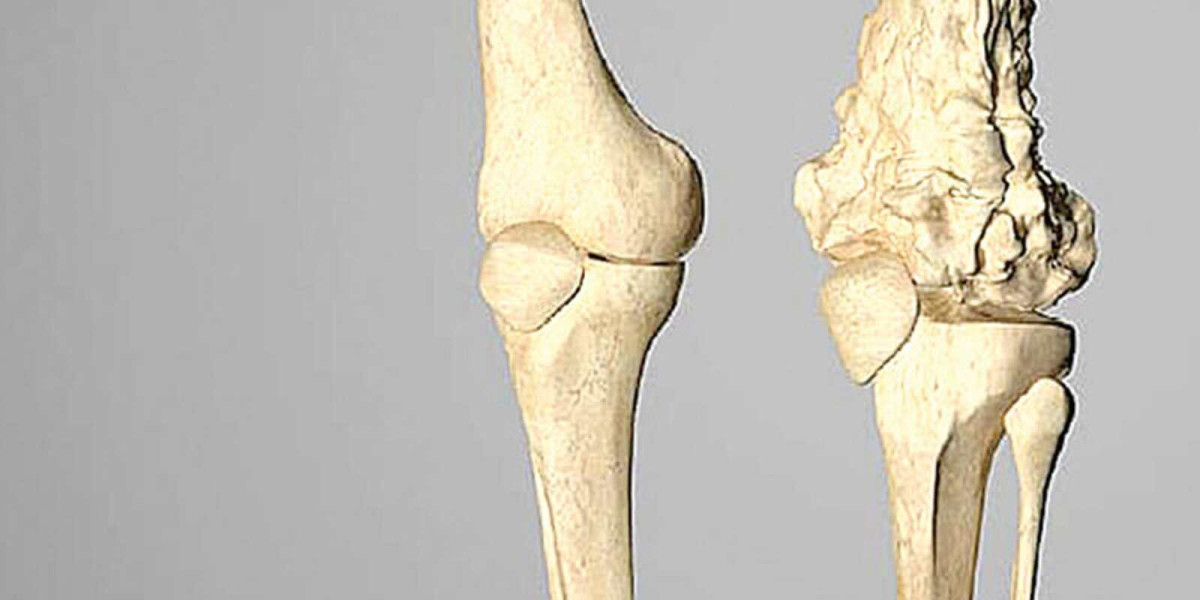 Is it possible to develop bone cancer even if the rest of the body is healthy?