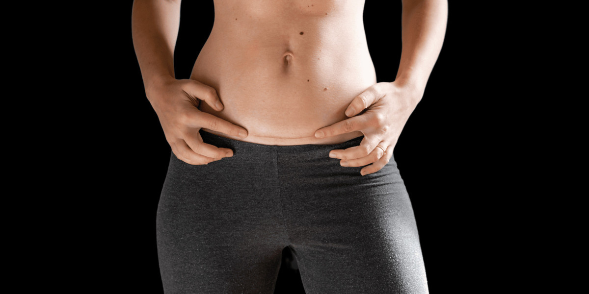 Tummy Tuck Procedure: What Happens Before, During, and After