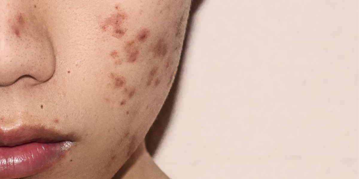 Non-Invasive Acne Scar Treatment Techniques