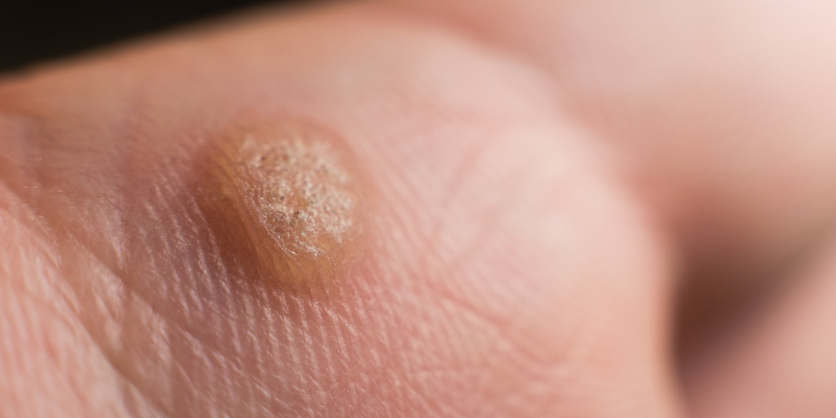 The Role of Salicylic Acid to Help Remove Warts Efficiently