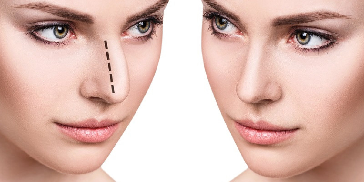 Top 10 Reasons to Choose Rhinoplasty Surgery