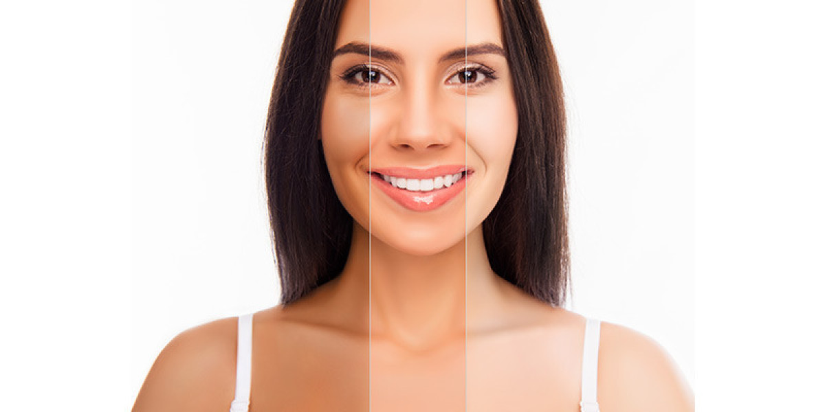 High-End Whitening Procedures: Are They Worth It in Islamabad?