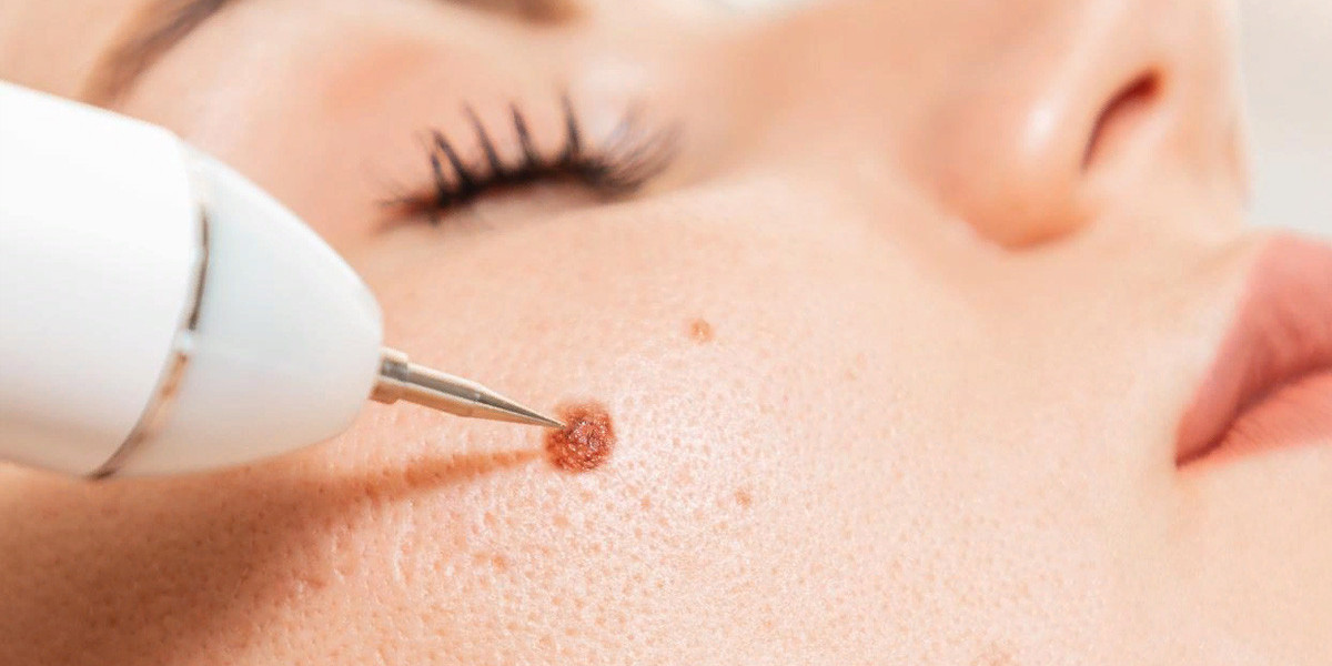 Common Myths About Warts Removal in Islamabad