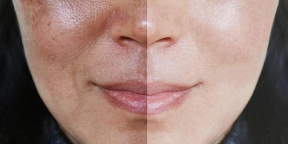 What Are the Latest Non-Invasive Melasma Treatments in Dubai?