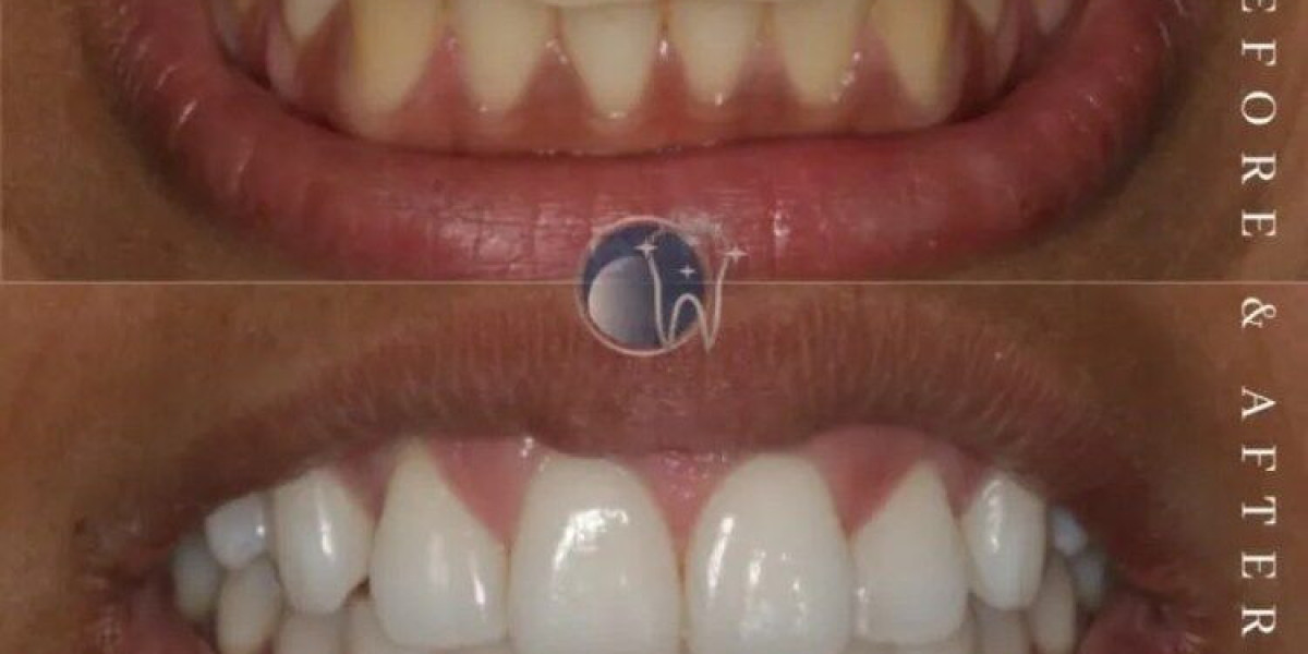 Transform Your Smile with Crest Whitestrips from The White Smiles