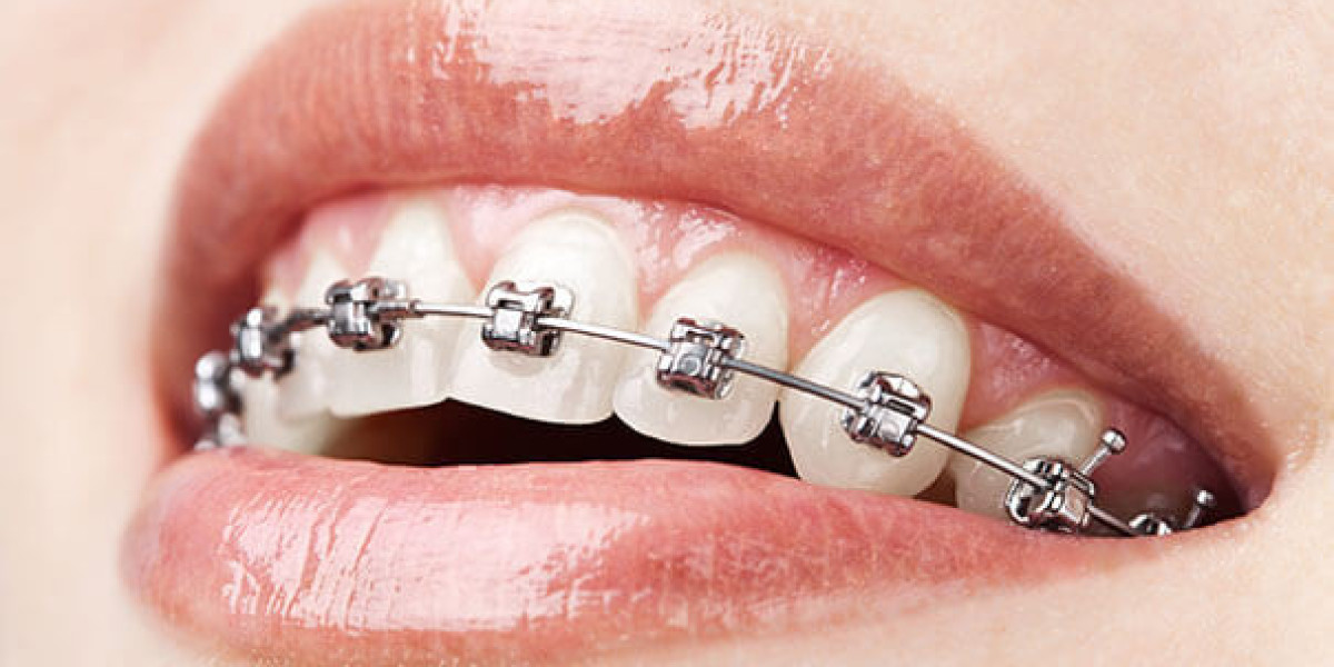 Understanding the Importance of Braces Treatment