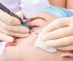 Skin Tags Removal in Dubai for Healthy and Smooth Skin